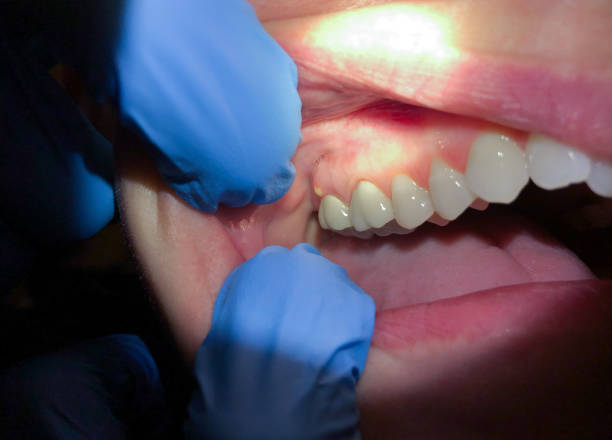 Best Emergency Dentist for Knocked-Out Tooth in Garner, NC