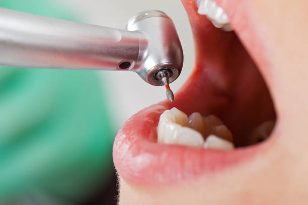 Best Emergency Dentist for Lost Fillings or Crowns in Garner, NC